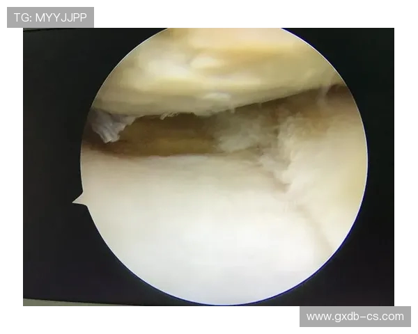 主刀医生透露迪巴拉外侧半月板完全撕裂术后恢复需45天时间